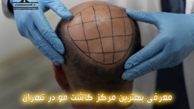 کلینیک کاشت مو در تهران