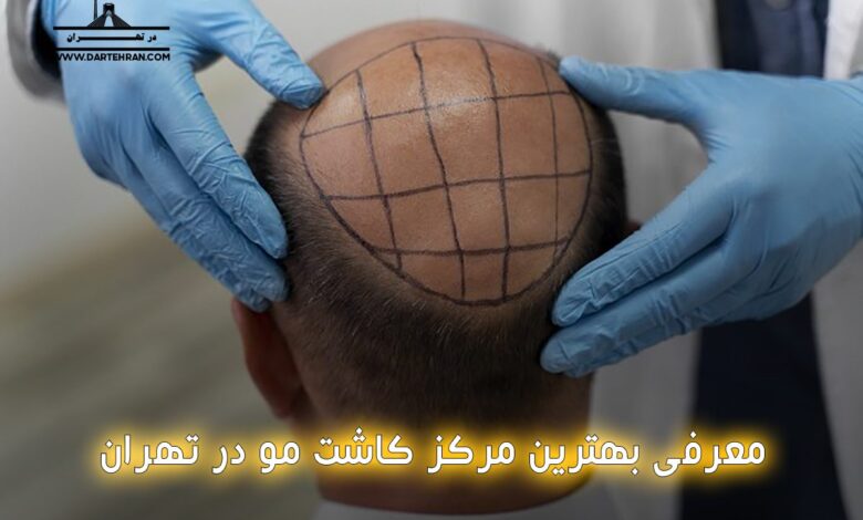 کلینیک کاشت مو در تهران