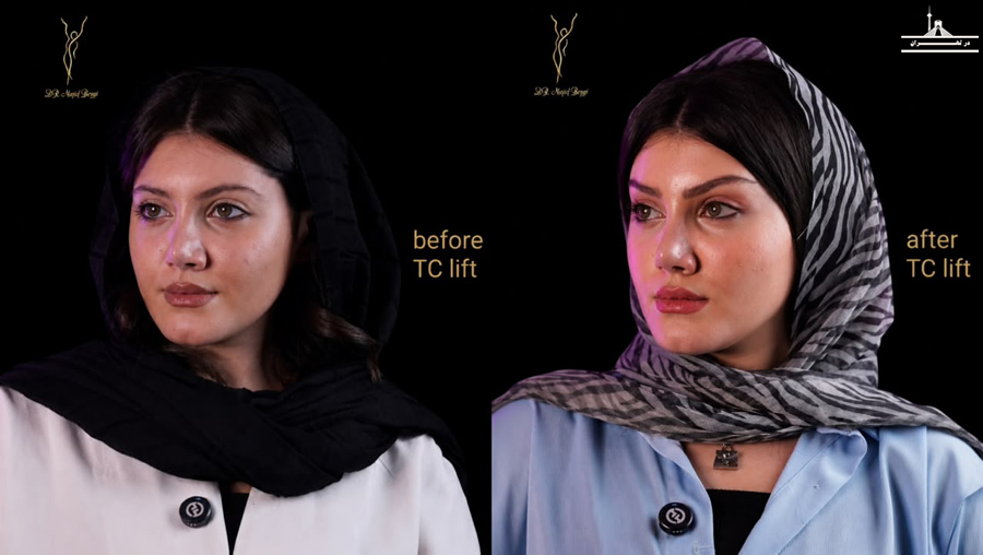 بهترین فوق تخصص جراح پلاستیک تهران 25 پزشک + ویدئو لیفت صورت توسط دکتر نجف بیگی