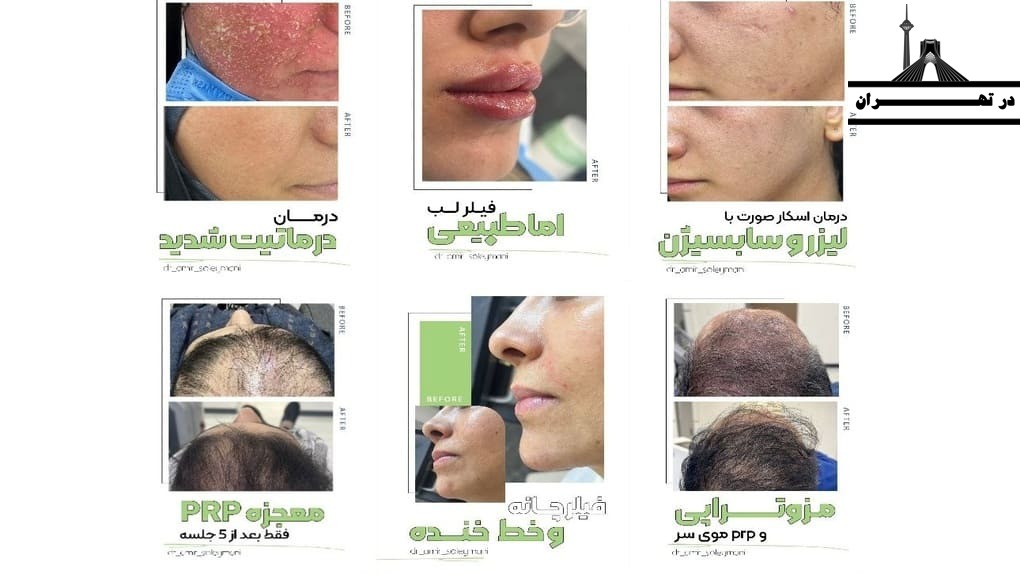 اینستاگرام مرکز برداشتن خال با لیزر بدون جای زخم دکتر امیر سلیمانی