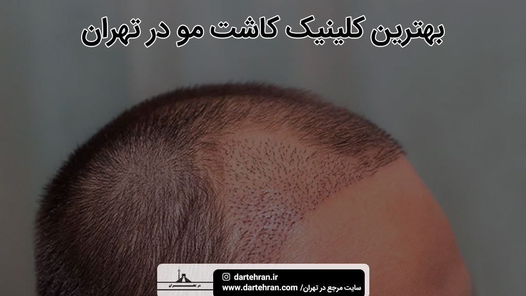 کلینیک کاشت مو در تهران