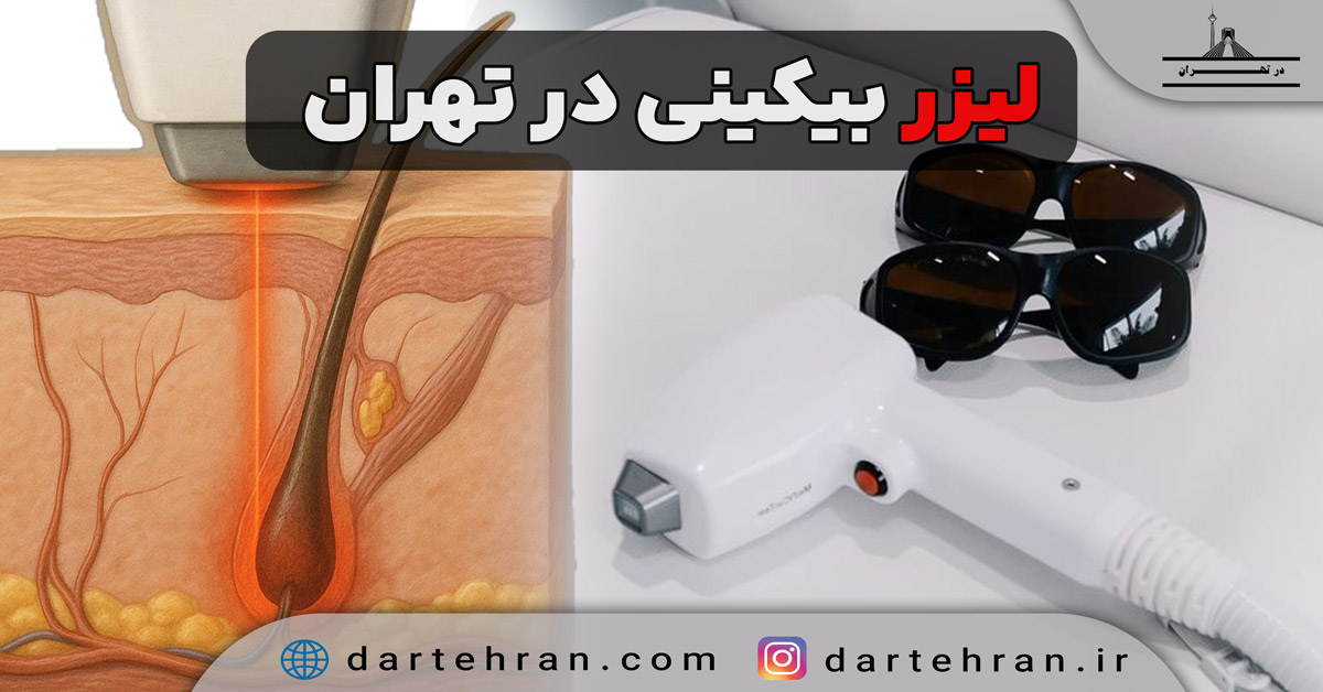 لیزر بیکینی در تهران