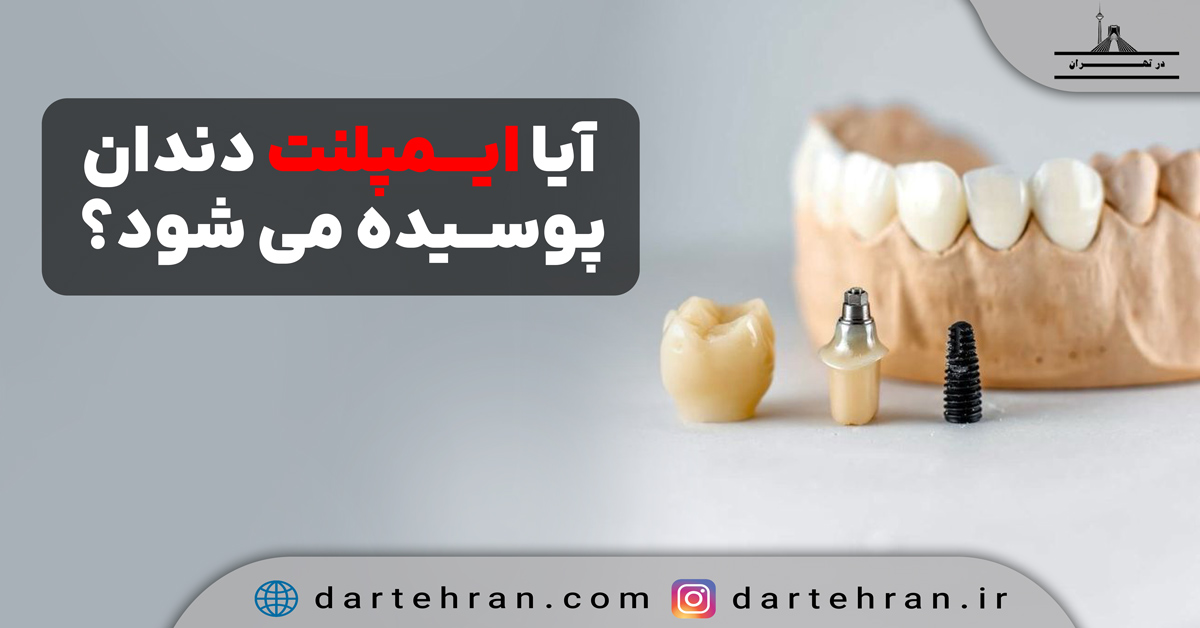 آیا ایمپلنت دندان پوسیده می شود؟