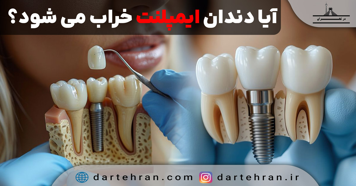 آیا دندان ایمپلنت خراب میشود؟ علائم، دلایل و راهکار پیشگیری آیا دندان ایمپلنت خراب میشود؟